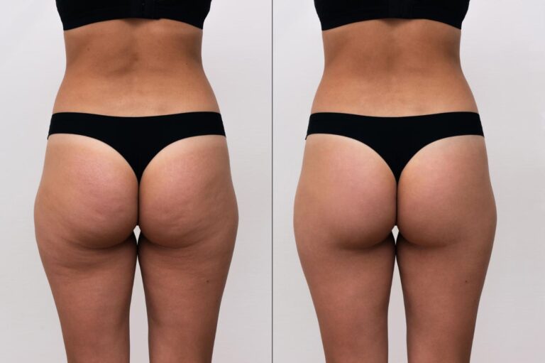 masaje anticelulítico Class Skin Wellness Center